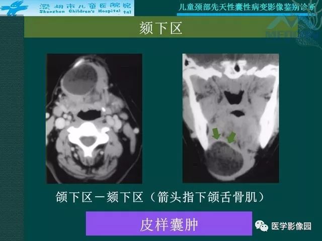 【PPT】儿童颈部先天性囊性病变影像鉴别诊断