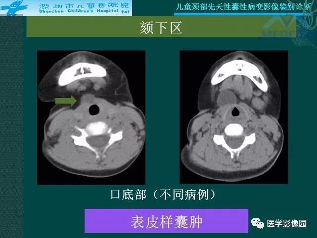 【PPT】儿童颈部先天性囊性病变影像鉴别诊断