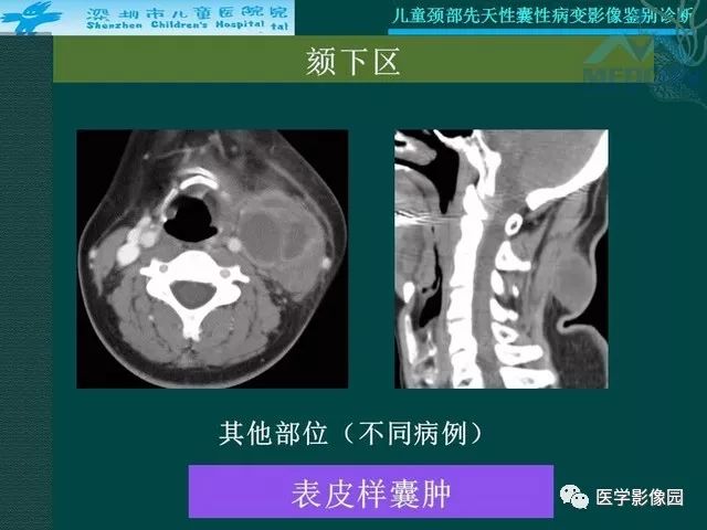 【PPT】儿童颈部先天性囊性病变影像鉴别诊断