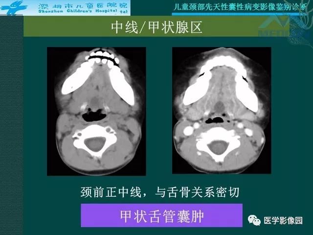 【PPT】儿童颈部先天性囊性病变影像鉴别诊断