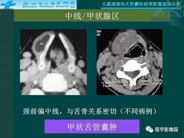【PPT】儿童颈部先天性囊性病变影像鉴别诊断