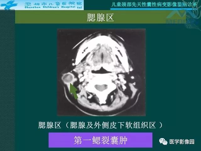 【PPT】儿童颈部先天性囊性病变影像鉴别诊断