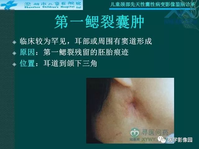 【PPT】儿童颈部先天性囊性病变影像鉴别诊断