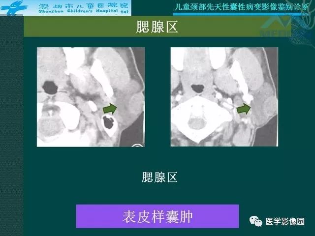 【PPT】儿童颈部先天性囊性病变影像鉴别诊断