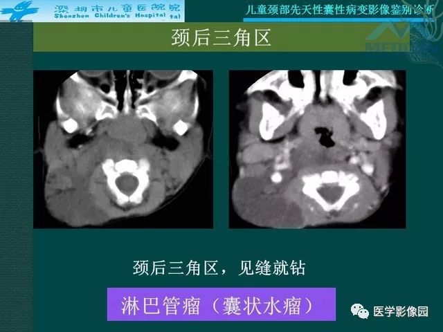 【PPT】儿童颈部先天性囊性病变影像鉴别诊断