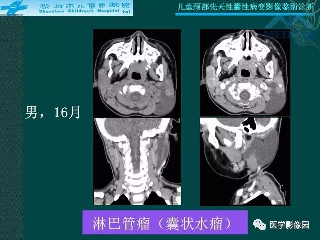 【PPT】儿童颈部先天性囊性病变影像鉴别诊断