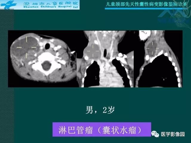 【PPT】儿童颈部先天性囊性病变影像鉴别诊断