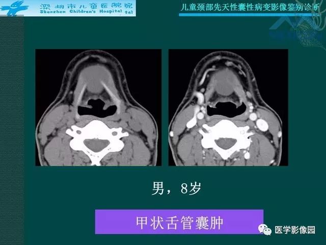 【PPT】儿童颈部先天性囊性病变影像鉴别诊断
