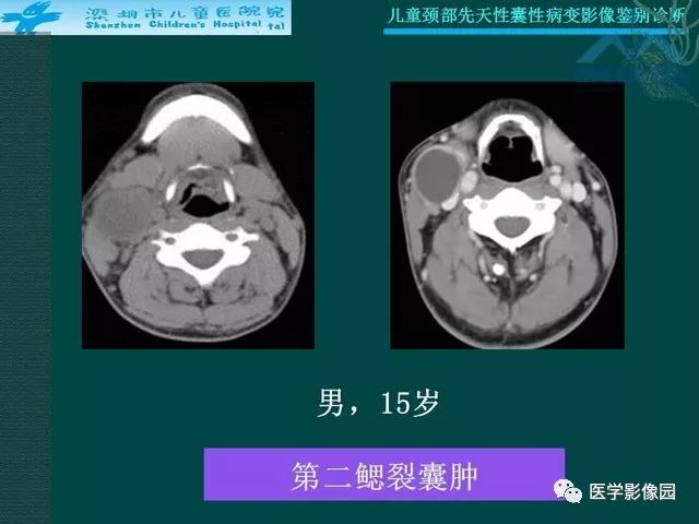【PPT】儿童颈部先天性囊性病变影像鉴别诊断