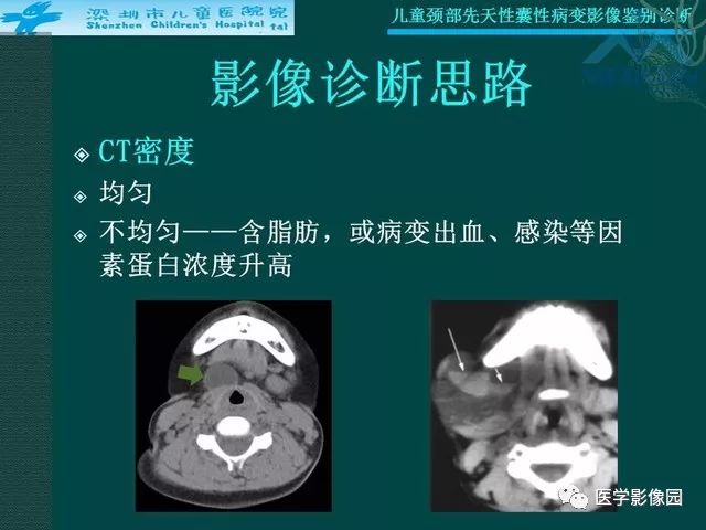 【PPT】儿童颈部先天性囊性病变影像鉴别诊断