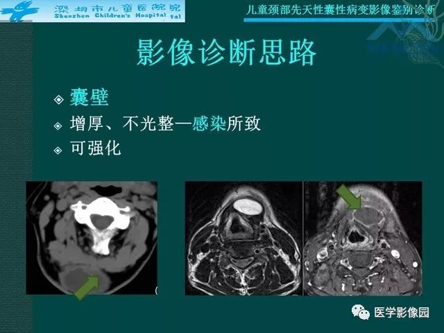 【PPT】儿童颈部先天性囊性病变影像鉴别诊断