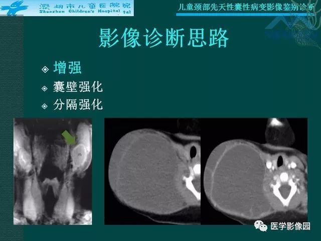【PPT】儿童颈部先天性囊性病变影像鉴别诊断