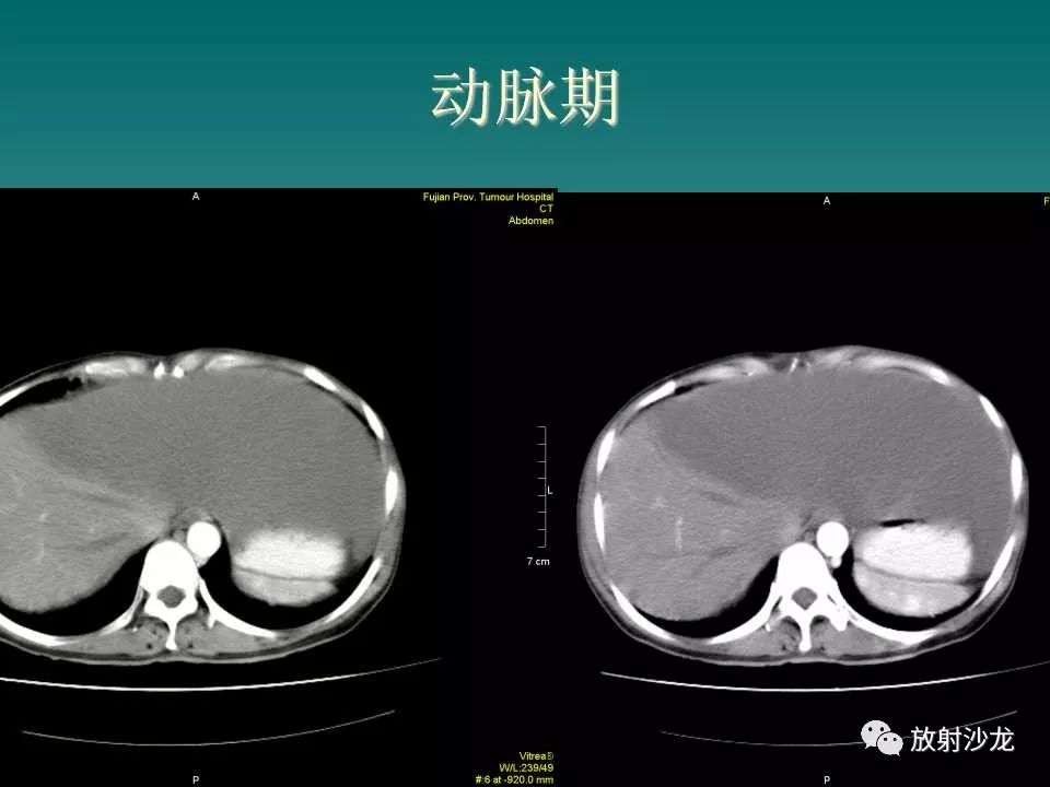 【病例】肝脏蔓状血管瘤1例CT影像表现