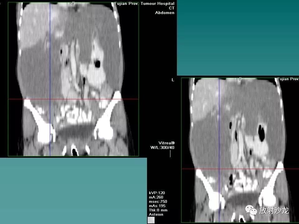 【病例】肝脏蔓状血管瘤1例CT影像表现