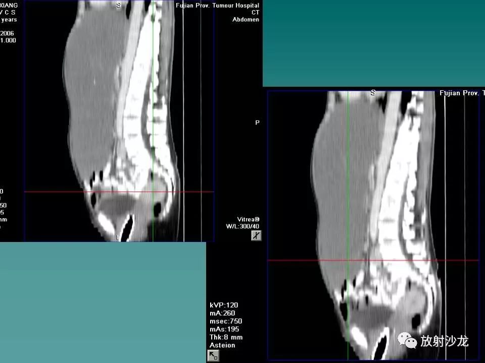 【病例】肝脏蔓状血管瘤1例CT影像表现