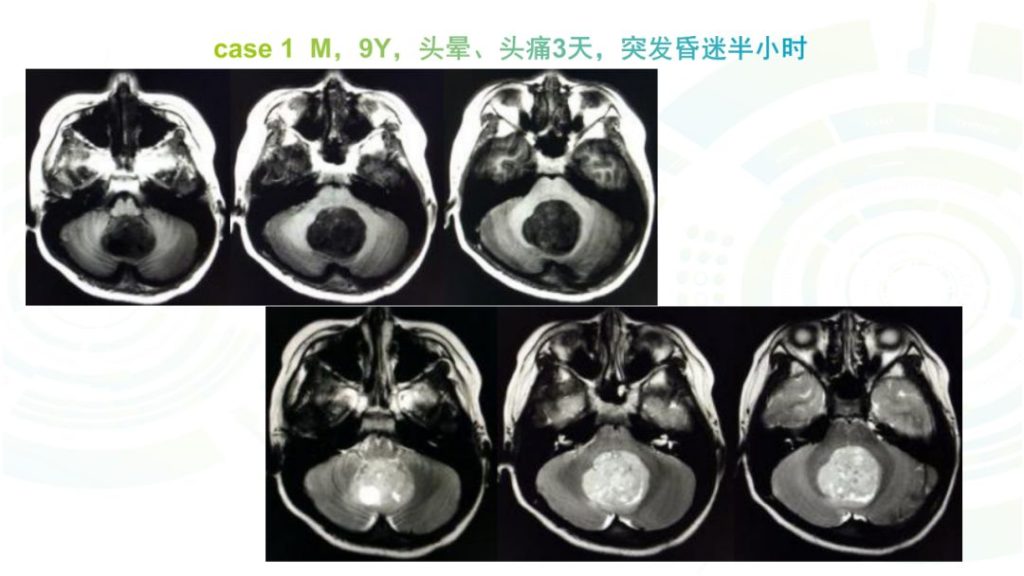 【病例】髓母细胞瘤2例MR影像鉴别诊断