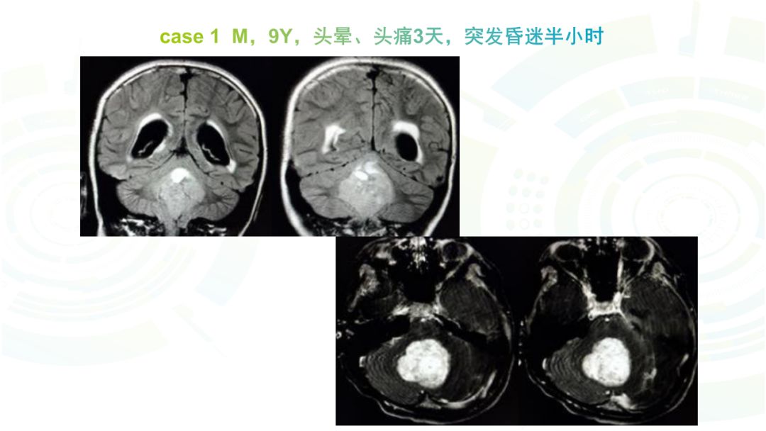 【病例】髓母细胞瘤2例MR影像鉴别诊断