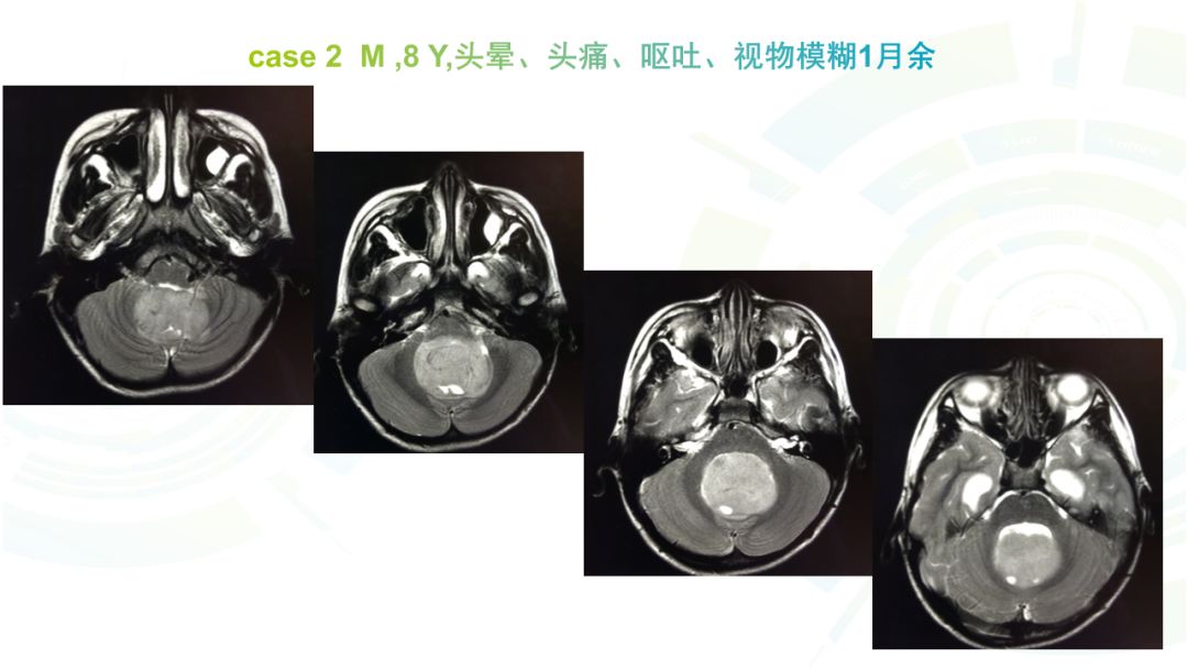 【病例】髓母细胞瘤2例MR影像鉴别诊断