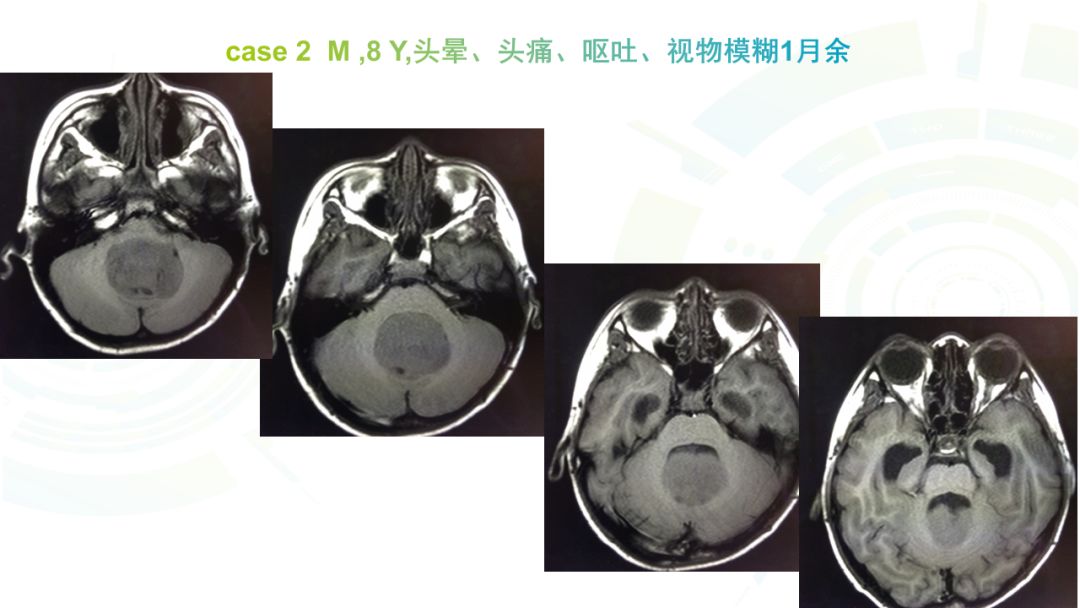【病例】髓母细胞瘤2例MR影像鉴别诊断