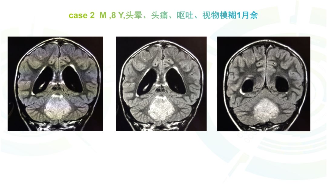 【病例】髓母细胞瘤2例MR影像鉴别诊断
