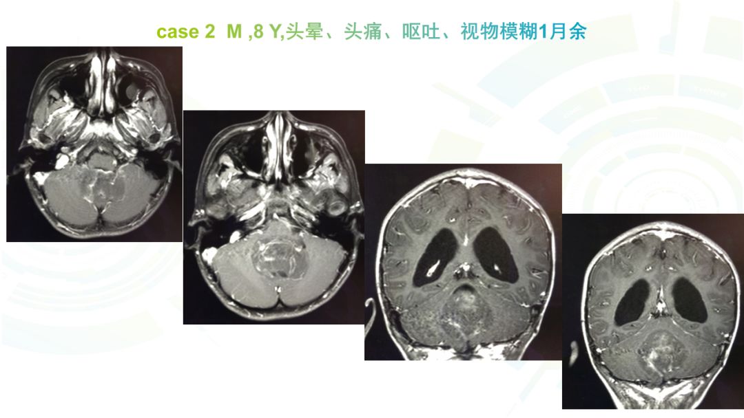 【病例】髓母细胞瘤2例MR影像鉴别诊断