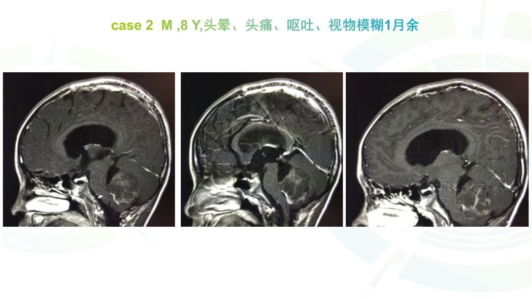 【病例】髓母细胞瘤2例MR影像鉴别诊断