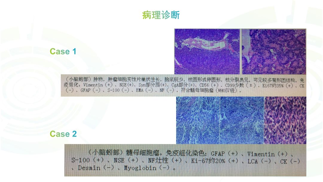 【病例】髓母细胞瘤2例MR影像鉴别诊断