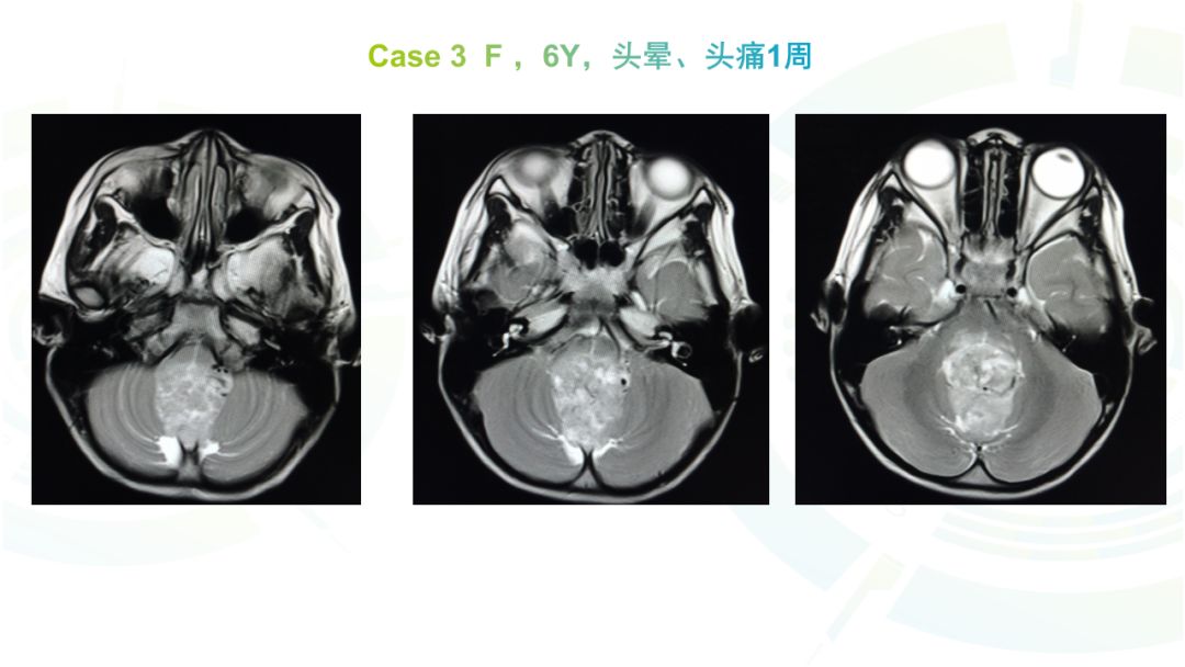 【病例】髓母细胞瘤2例MR影像鉴别诊断