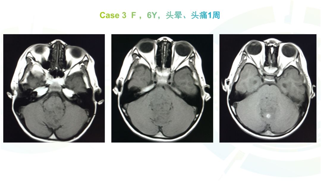 【病例】髓母细胞瘤2例MR影像鉴别诊断