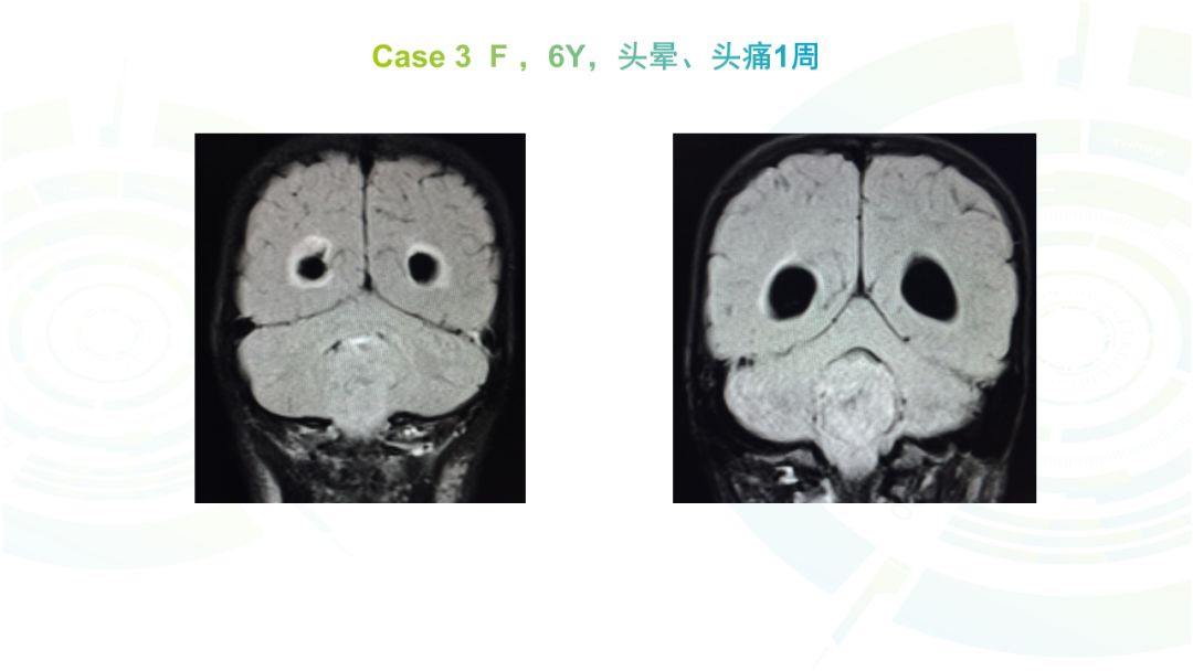 【病例】髓母细胞瘤2例MR影像鉴别诊断
