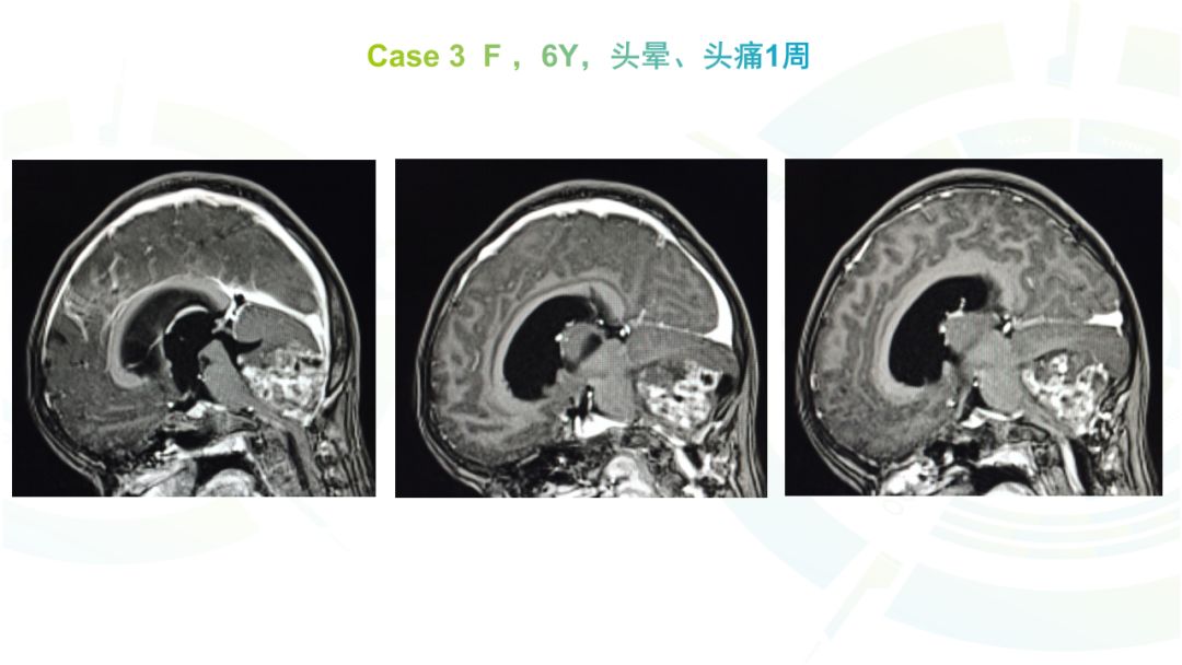 【病例】髓母细胞瘤2例MR影像鉴别诊断