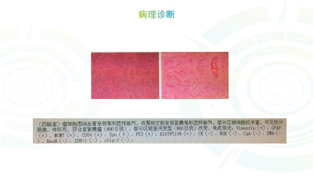 【病例】髓母细胞瘤2例MR影像鉴别诊断