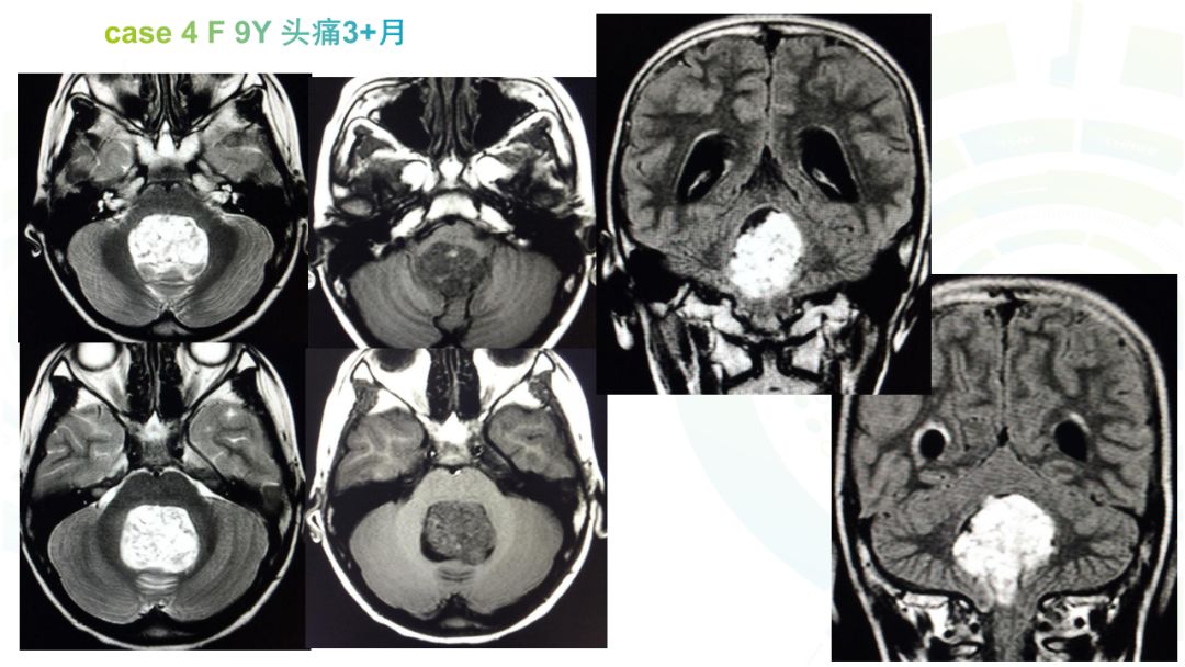 【病例】髓母细胞瘤2例MR影像鉴别诊断
