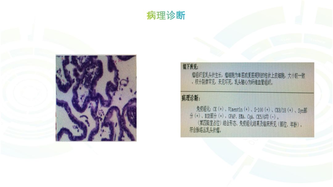 【病例】髓母细胞瘤2例MR影像鉴别诊断