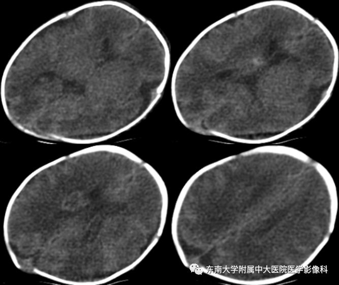 【病例】早产儿缺血缺氧性脑病1例MR 【病例】早产儿缺血缺氧性脑病1例MR