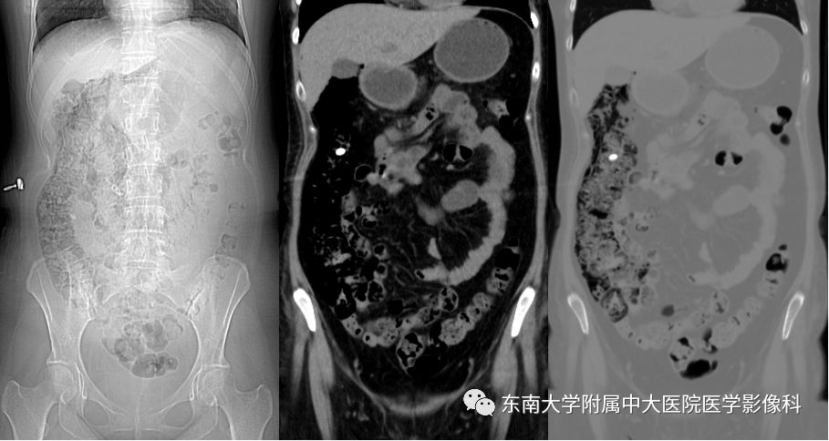 【病例】肠气囊肿症1例CT影像诊断