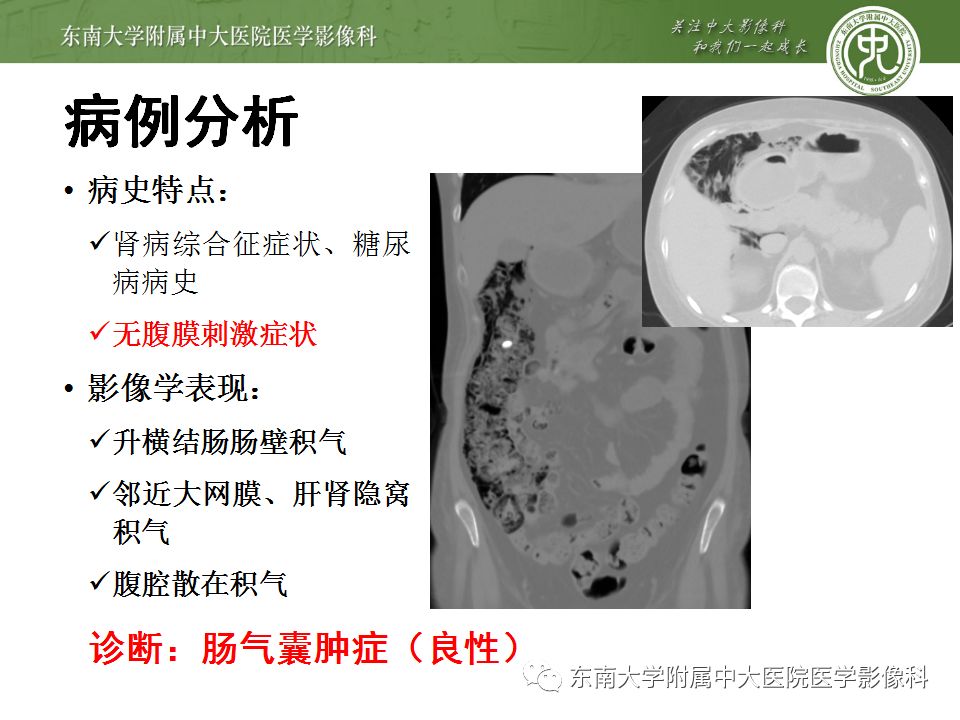 【病例】肠气囊肿症1例CT影像诊断