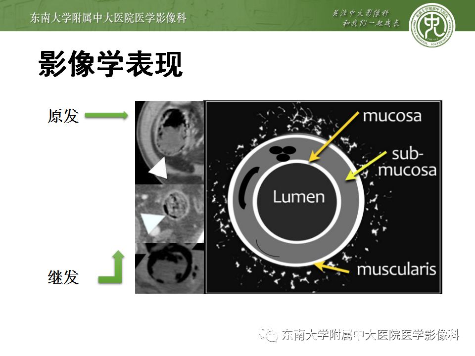 【病例】肠气囊肿症1例CT影像诊断
