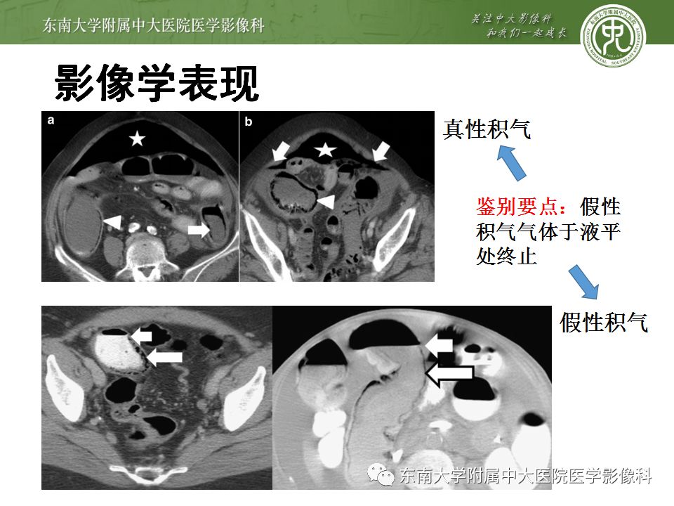 【病例】肠气囊肿症1例CT影像诊断