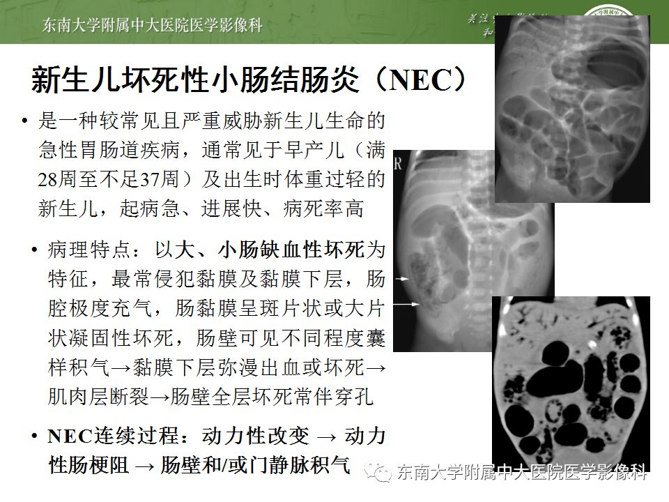 【病例】肠气囊肿症1例CT影像诊断