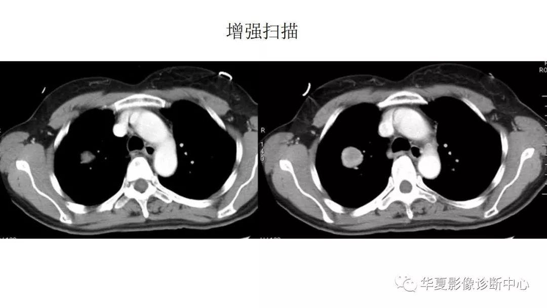 【病例】肺硬化性血管瘤1例CT影像表现