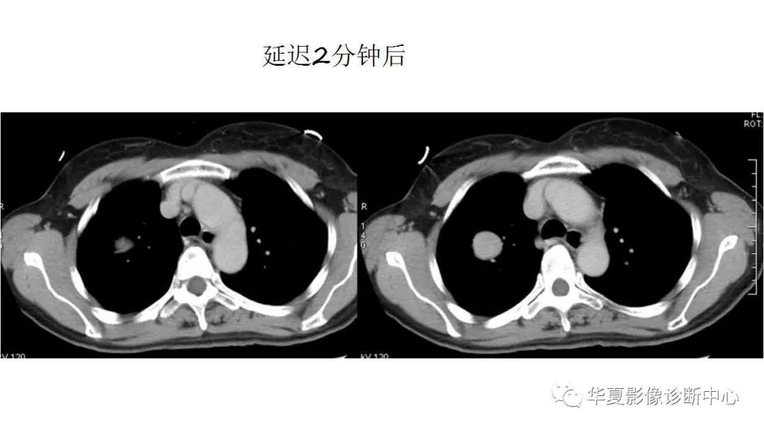 【病例】肺硬化性血管瘤1例CT影像表现