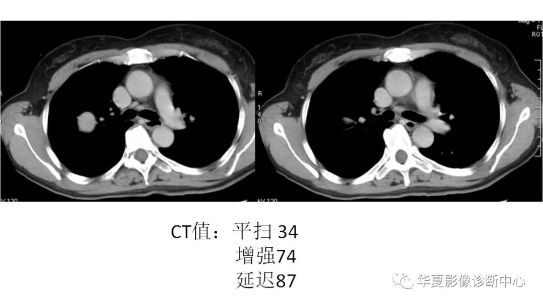 【病例】肺硬化性血管瘤1例CT影像表现