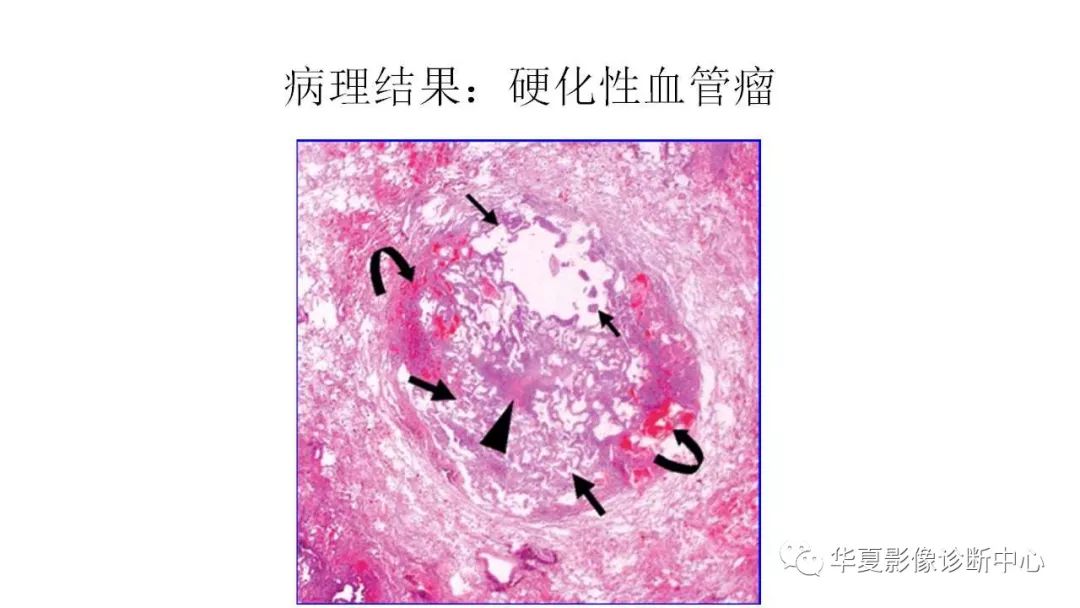 【病例】肺硬化性血管瘤1例CT影像表现