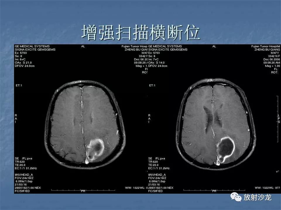 【病例】脑脓肿1例MR影像表现