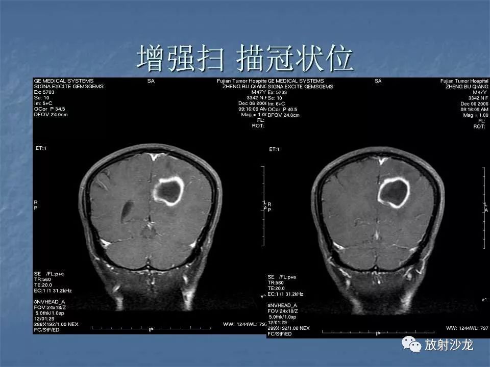 【病例】脑脓肿1例MR影像表现