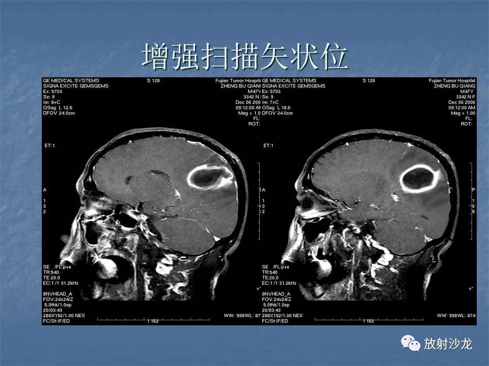 【病例】脑脓肿1例MR影像表现