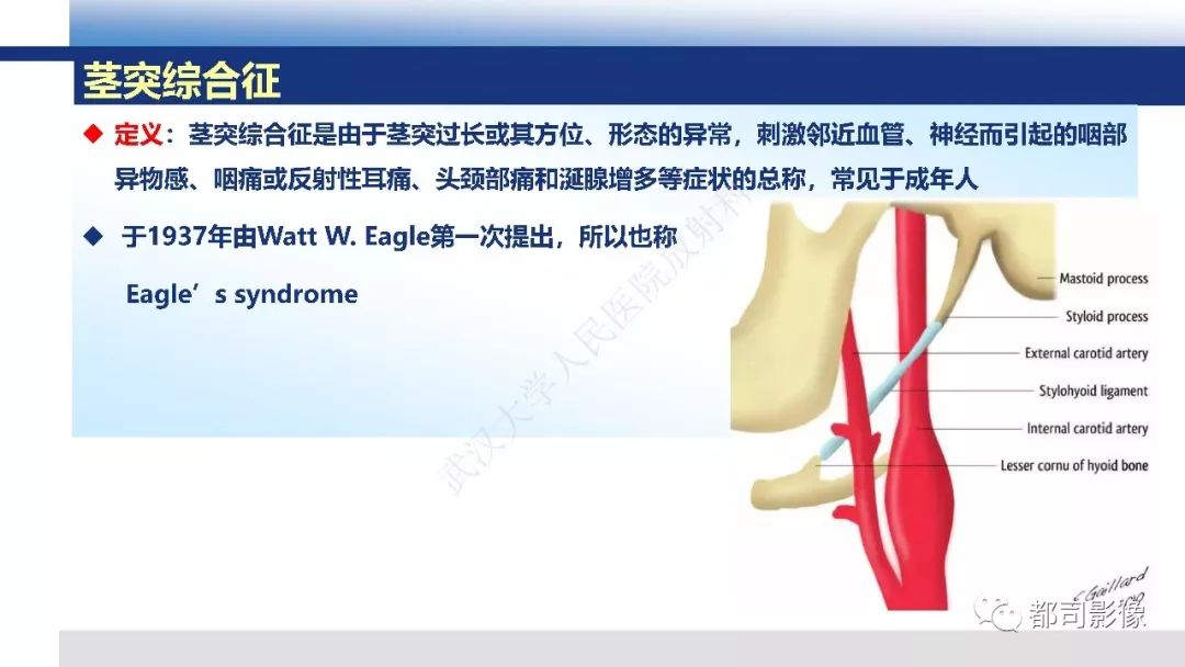 【PPT】茎突综合征影像诊断