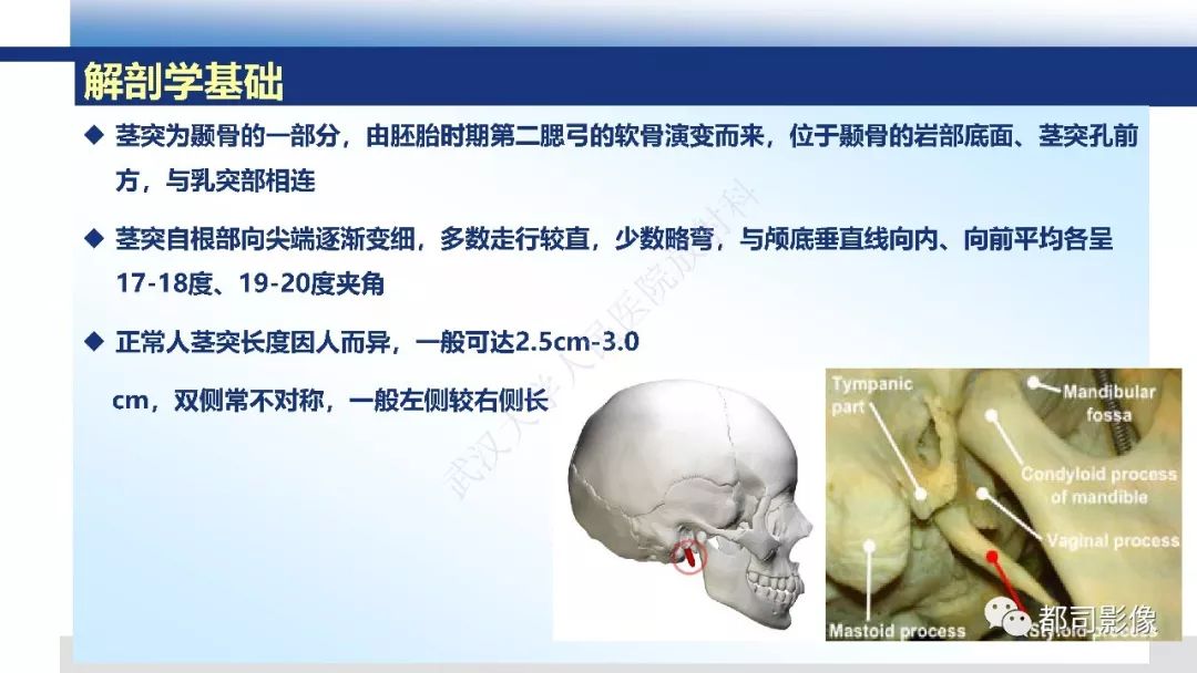 【PPT】茎突综合征影像诊断
