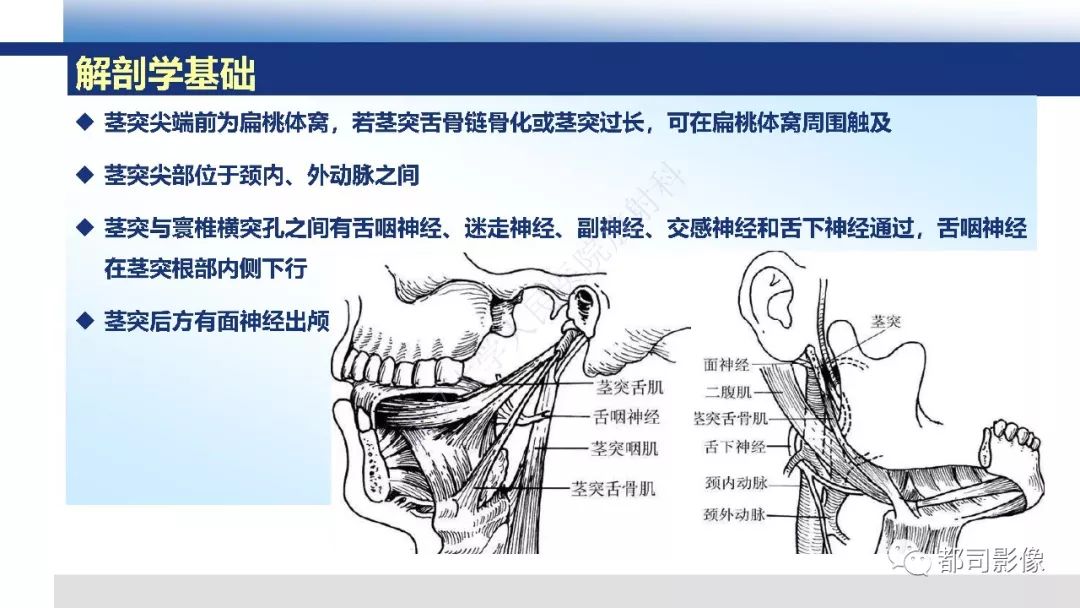 【PPT】茎突综合征影像诊断